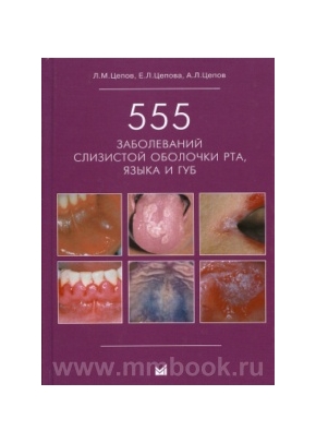 555 заболеваний слизистой оболочки рта