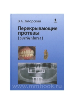 Перекрывающие протезы