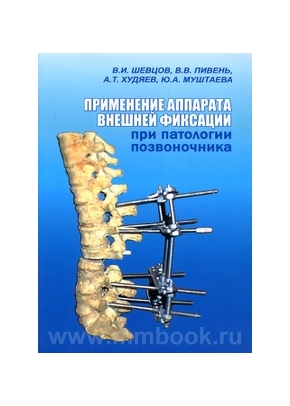 Применение аппарата внешней фиксации при патологии позвоночника