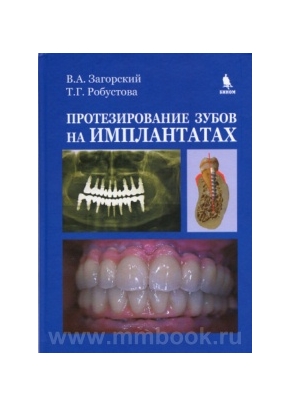 Протезирование зубов на имплантатах