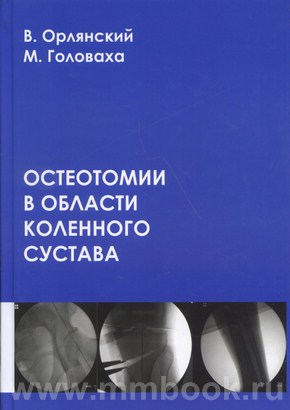 Остеотомии в области коленного сустава