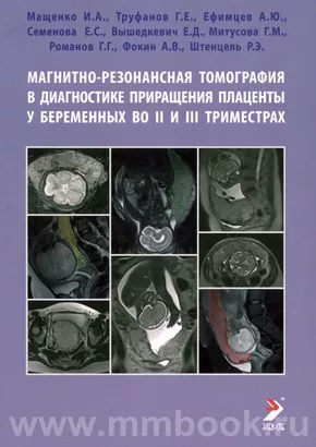 Магнитно-резонансная томография в диагностике приращения плаценты у беременных во II и III триместрах
