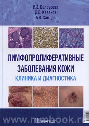 Белоусова И. Э. - Лимфопролиферативные заболевания кожи. Клиника и диагностика