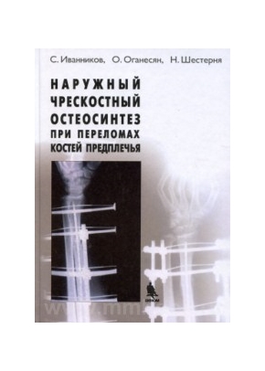 Наружный чрескостный остеосинтез при переломах костей предплечья