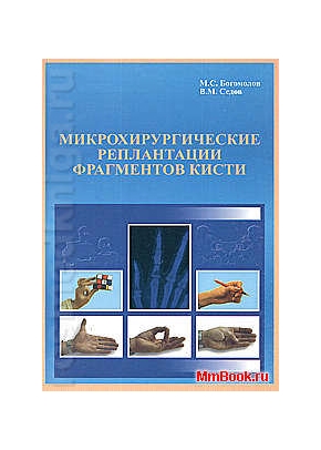 Микрохирургические реплантации фрагментов кисти