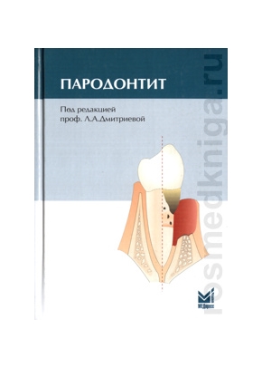 Пародонтит