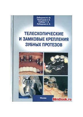 Телескопические и замковые крепления зубных протезов