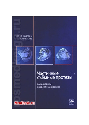Частичные съемные протезы