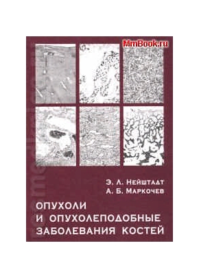 Опухоли и опухолеподобные заболевания костей