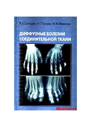 Диффузные болезни соединительной ткани