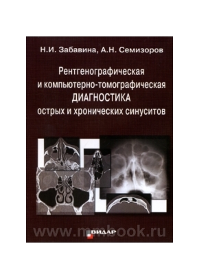 Рентгенографическая и компьютерно-томографическая диагностика острых и хронических синуситов