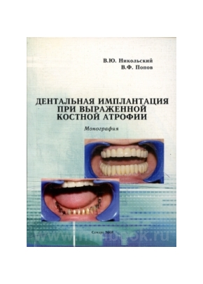 Дентальная имплантация при выраженной костной атрофии. Монография