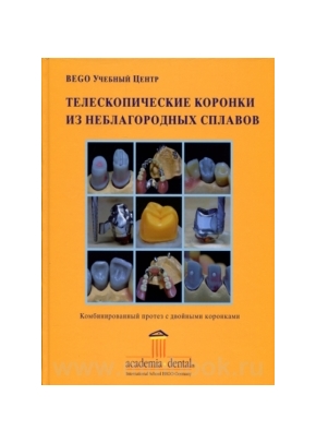 Телескопические коронки из неблагородных сплавов Руководство для изготовления