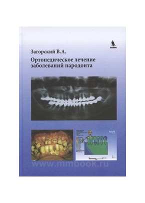 Ортопедическое лечение заболеваний пародонта