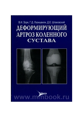 Деформирующий артроз коленного сустава: руководство