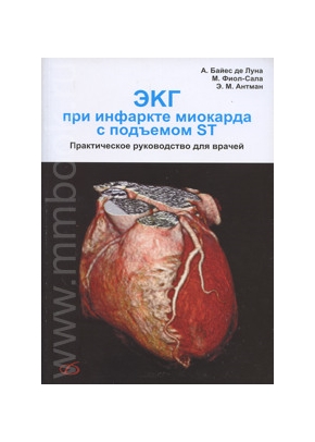 ЭКГ при инфаркте миокарда с подъемом ST