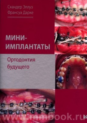 Эллуз С. - Мини-имплантаты. Ортодонтия будущего
