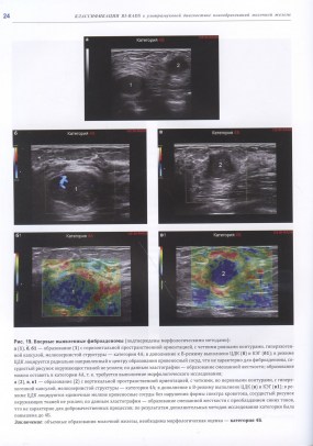 Фисенко Е.П. - Классификация BI-RADS в ультразвуковой диагностике новообразований молочной железы