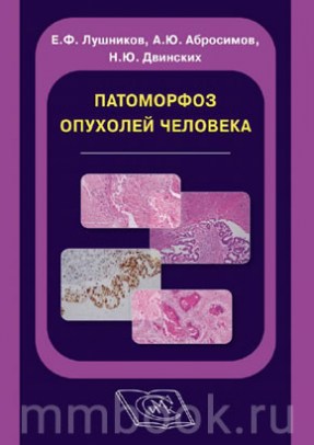 Патоморфоз опухолей человека