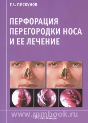 Перфорация перегородки носа и ее лечение Перфорация перегородки носа и ее лечение