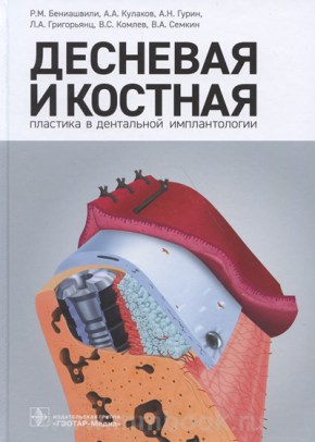 Десневая и костная пластика в дентальной имплантологии
