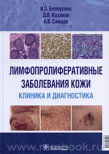 Лимфопролиферативные заболевания кожи. Клиника и диагностика